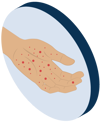 Stage 2: rashes and flu-like symptoms may develop, then disappear even without treatment.
