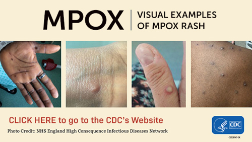 Mpox visual examples of rash