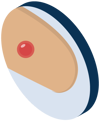 Syphilis: Stage 1 - small red sore
